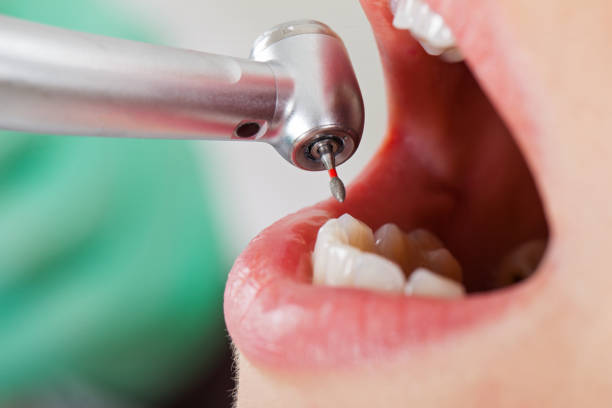 Best Emergency Wisdom Tooth Extraction in Neenah, WI